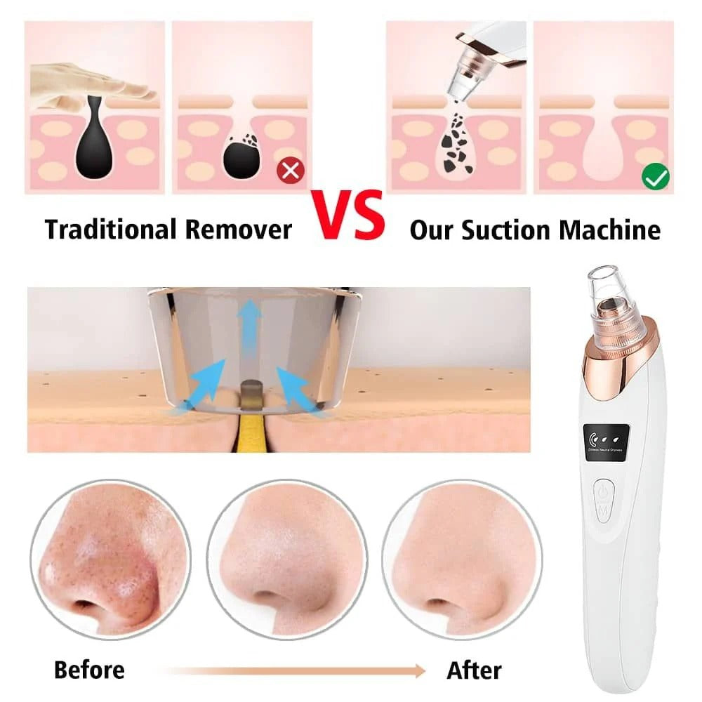 5 in 1 Electric Blackhead Remover Vacuum – Deep Pore Cleaner, Acne Removal Tool with 5 Suction Heads for Clear Skin